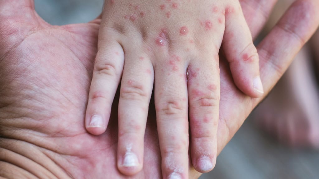 possible measles exposure toronto pearson airport.